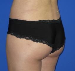 Brazilian Butt Lift Before & After Patient #280