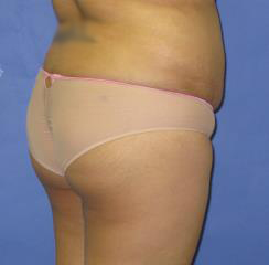 Brazilian Butt Lift Before & After Patient #285