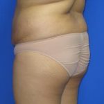 Brazilian Butt Lift Before & After Patient #285