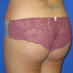 Brazilian Butt Lift Before & After Patient #285