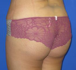 Brazilian Butt Lift Before & After Patient #285