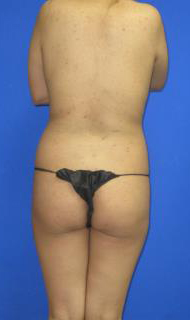 Liposuction Before & After Patient #296
