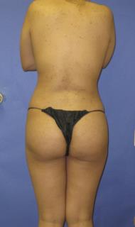 Liposuction Before & After Patient #296