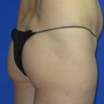 Brazilian Butt Lift Before & After Patient #301
