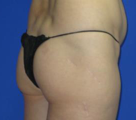 Brazilian Butt Lift Before & After Patient #301