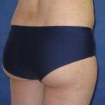 Brazilian Butt Lift Before & After Patient #301