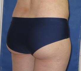 Brazilian Butt Lift Before & After Patient #301