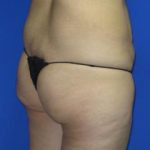 VASER Liposuction Before & After Patient #306