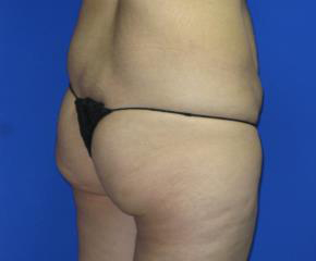 VASER Liposuction Before & After Patient #306