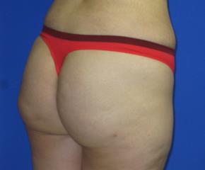 VASER Liposuction Before & After Patient #306