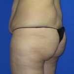 VASER Liposuction Before & After Patient #306