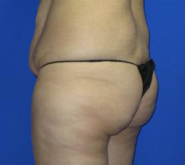 VASER Liposuction Before & After Patient #306