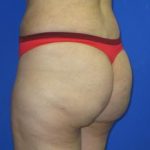 VASER Liposuction Before & After Patient #306