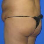 VASER Liposuction Before & After Patient #312