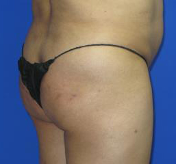 VASER Liposuction Before & After Patient #319