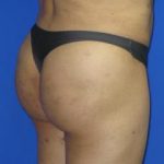 VASER Liposuction Before & After Patient #319