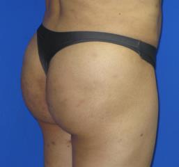 VASER Liposuction Before & After Patient #319