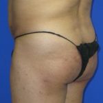 VASER Liposuction Before & After Patient #319