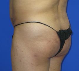 VASER Liposuction Before & After Patient #319