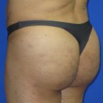 VASER Liposuction Before & After Patient #319