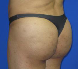 VASER Liposuction Before & After Patient #319