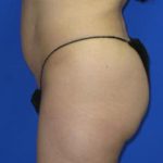 VASER Liposuction Before & After Patient #75