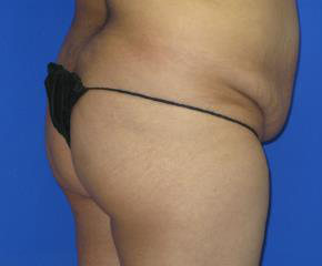 Liposuction Before & After Patient #114