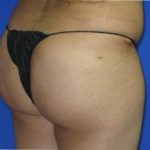 Liposuction Before & After Patient #114