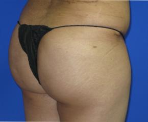 Liposuction Before & After Patient #114