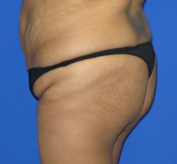 VASER Liposuction Before & After Patient #107