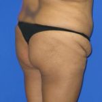 VASER Liposuction Before & After Patient #107
