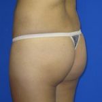 Brazilian Butt Lift Before & After Patient #82