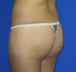 Brazilian Butt Lift Before & After Patient #82