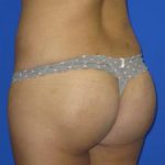 Brazilian Butt Lift Before & After Patient #82