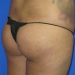 VASER Liposuction Before & After Patient #134