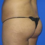 VASER Liposuction Before & After Patient #134