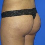 VASER Liposuction Before & After Patient #134