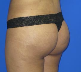 VASER Liposuction Before & After Patient #134