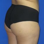VASER Liposuction Before & After Patient #87