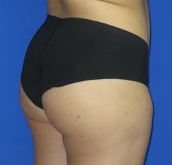 VASER Liposuction Before & After Patient #87