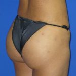 Brazilian Butt Lift Before & After Patient #98