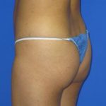 Brazilian Butt Lift Before & After Patient #98