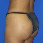 Brazilian Butt Lift Before & After Patient #98