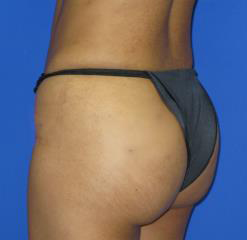 Brazilian Butt Lift Before & After Patient #98