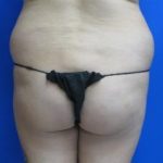 Liposuction Before & After Patient #120