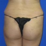 Liposuction Before & After Patient #120