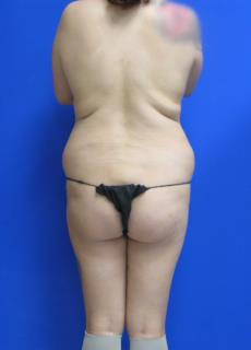 Liposuction Before & After Patient #120