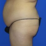 Brazilian Butt Lift Before & After Patient #155