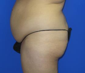 Brazilian Butt Lift Before & After Patient #155