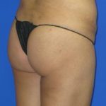VASER Liposuction Before & After Patient #181